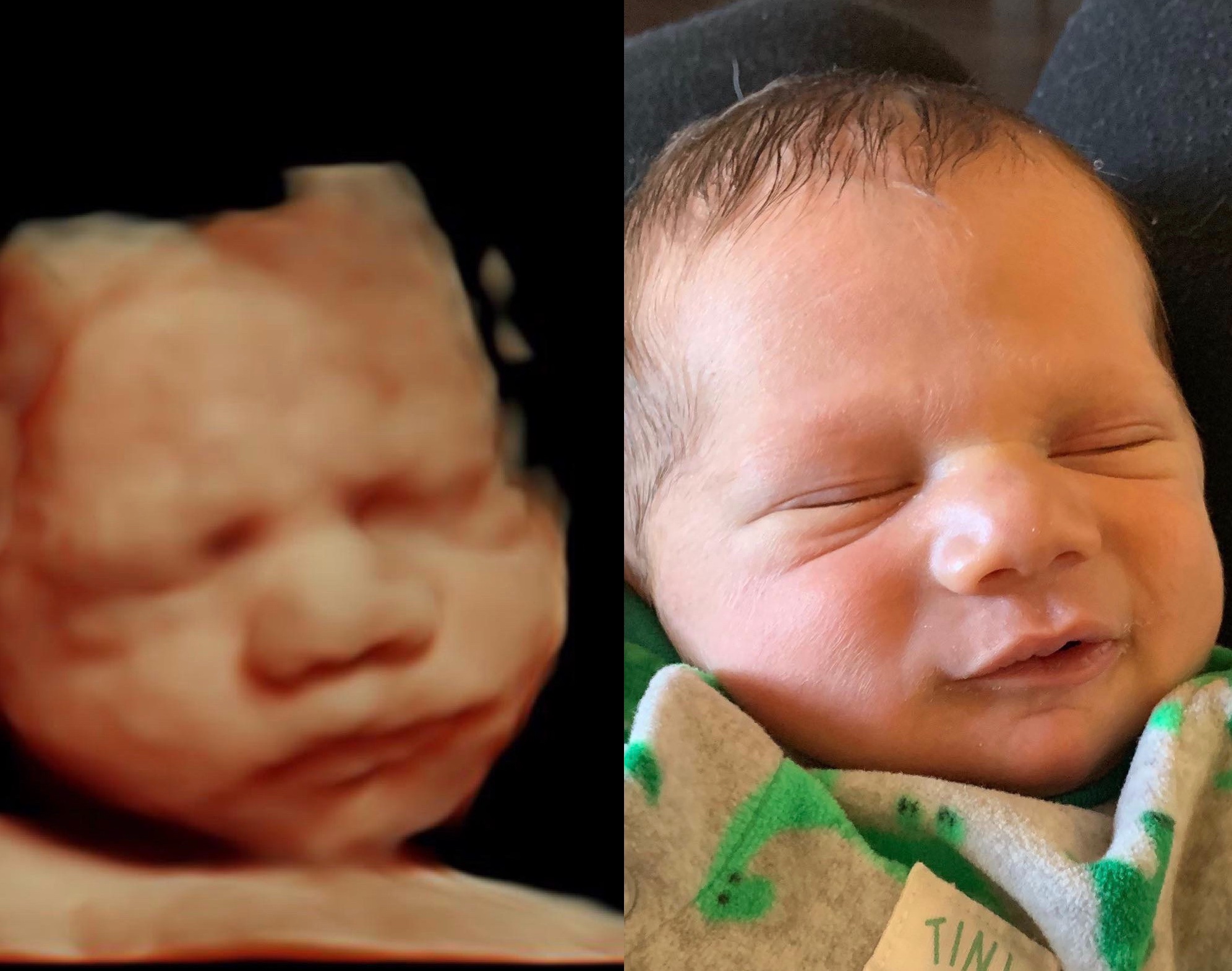 before & after - First Glimpse Ultrasound